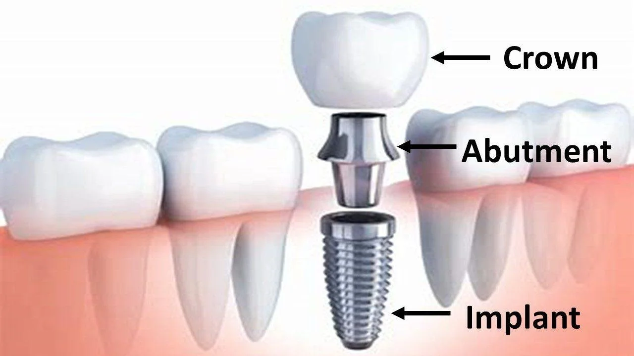 dental implant parts diagram showing crown abutment and implant post tooth replacement Fox Point WI dental implants near Bayside Shorewood Glendale