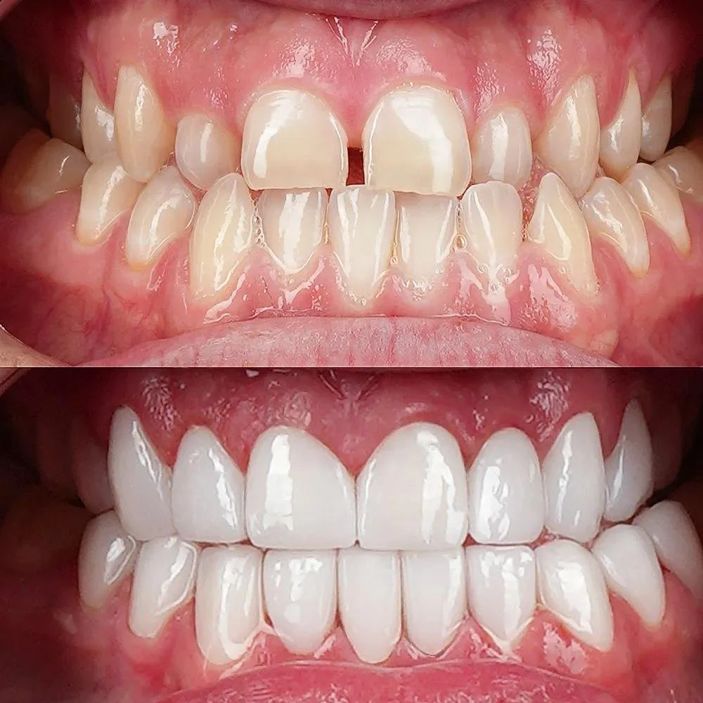 Before and after full smile makeover showing crowded, misaligned teeth corrected with cosmetic dentistry resulting in straight, white, natural-looking smile in Fox Point WI