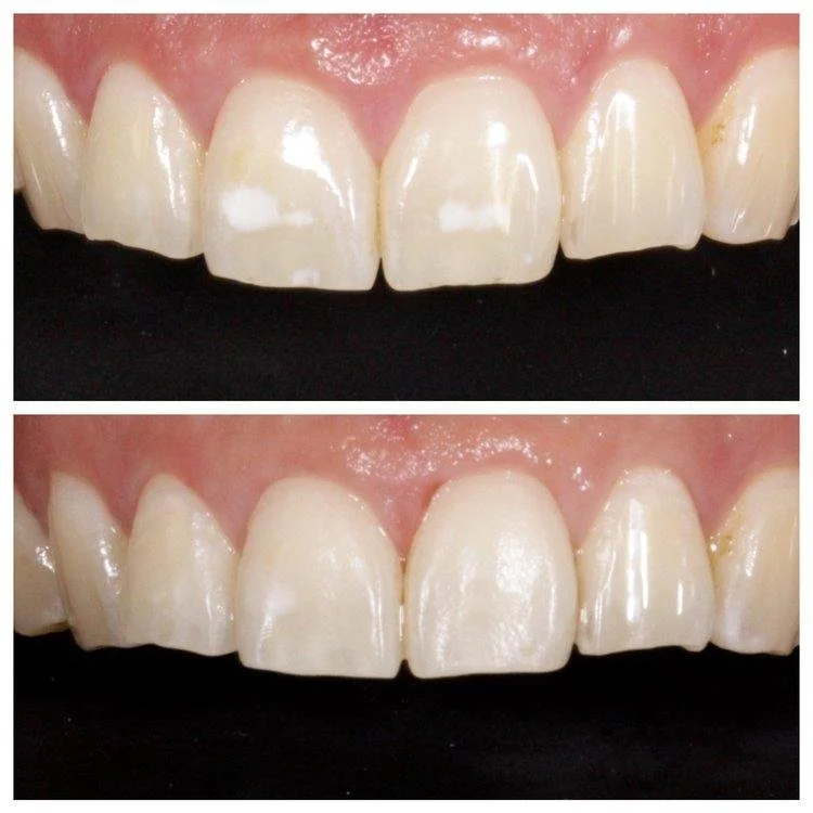 before and after cosmetic dentistry smile makeover veneers and teeth whitening Fox Point WI cosmetic dentist near Bayside Shorewood Glendale Wisconsin
