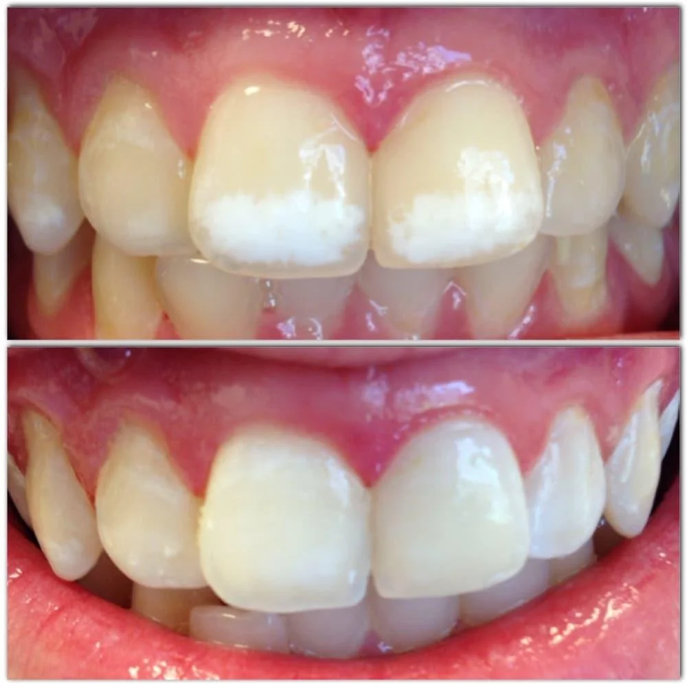 before and after ICON white spot removal treatment enamel repair cosmetic dentistry Fox Point WI dentist near Bayside Shorewood Glendale