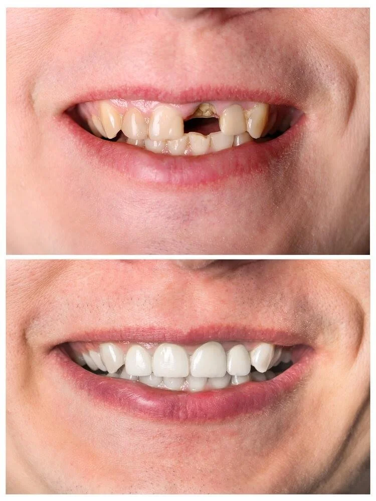 smile makeover dental bridges before and after cosmetic dentistry results Fox Point WI dentist veneers crowns near Bayside Shorewood Glendale