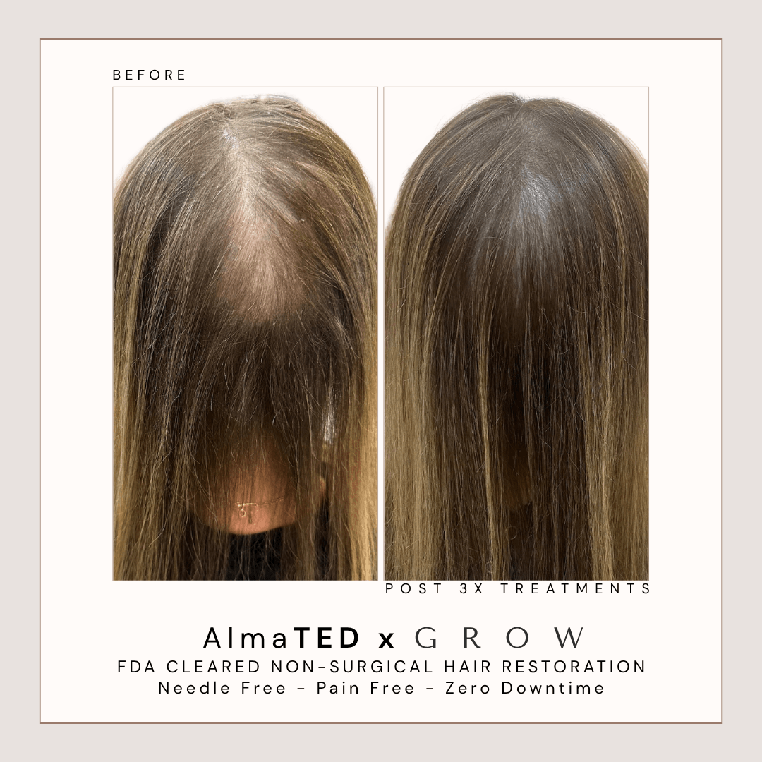 Before and after AlmaTED hair restoration treatment for female crown thinning at GROW Hair Lounge in Atlanta.