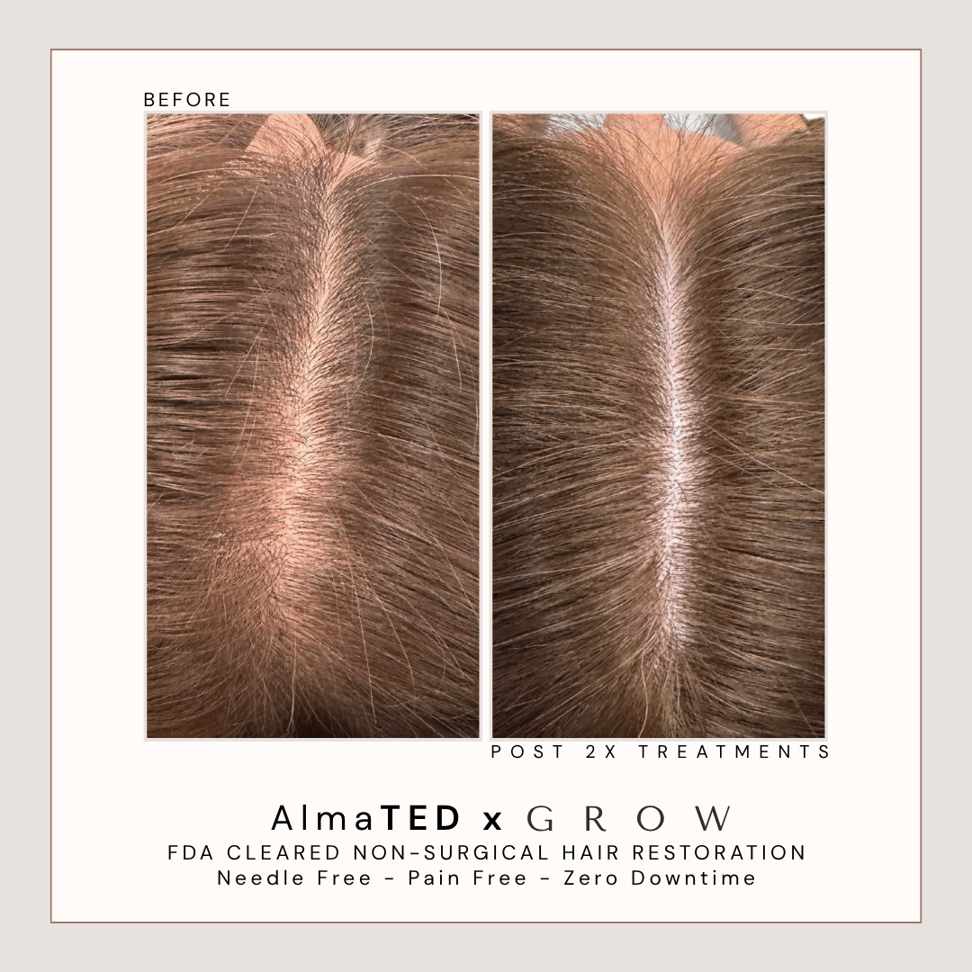 Before and after treatment for female partline thinning and scalp visibility using AlmaTED.