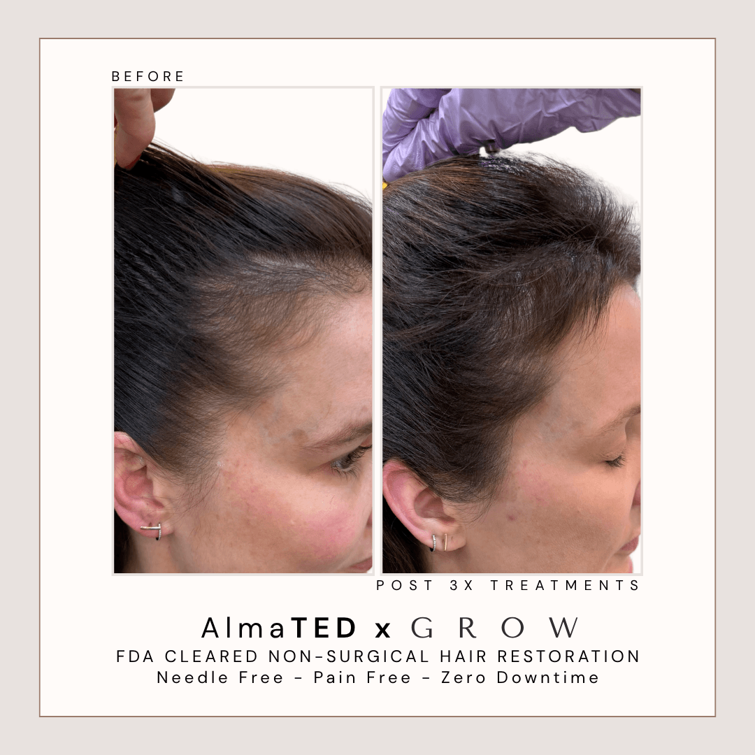 Before and after female hairline and edge regrowth treatment at GROW Hair Lounge in Atlanta.