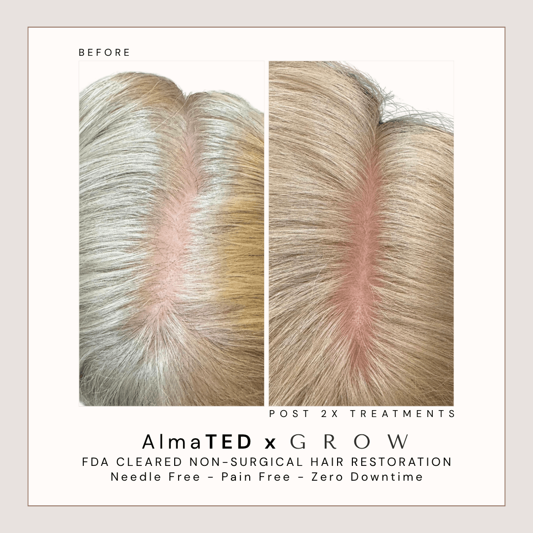 Before and after non-surgical hair restoration treatment for widening partline hair thinning in Atlanta.
