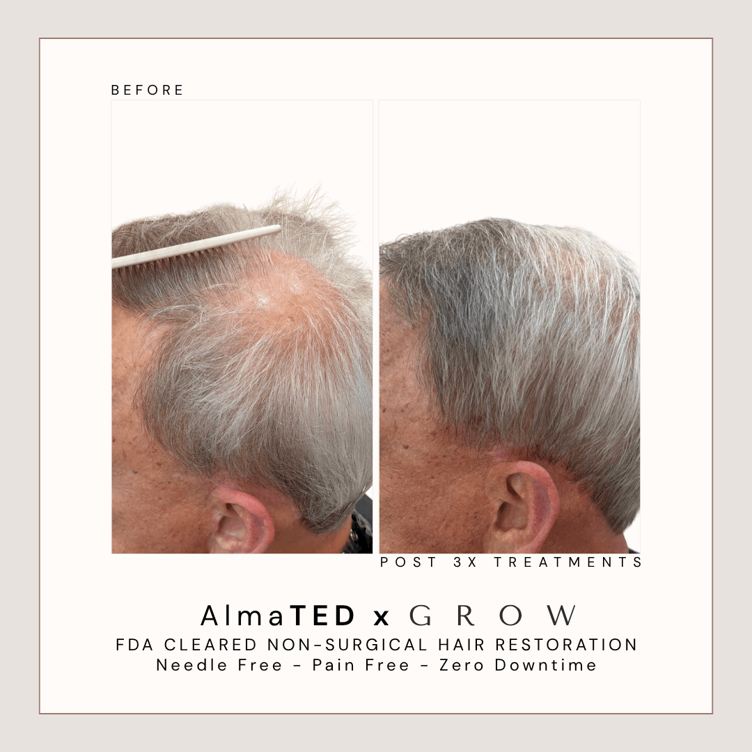 Before and after AlmaTED hair restoration results for male thinning hair and scalp density improvement.