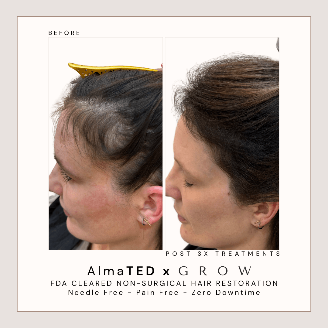 Before and after female hairline and edge regrowth treatment at GROW Hair Lounge in Atlanta.