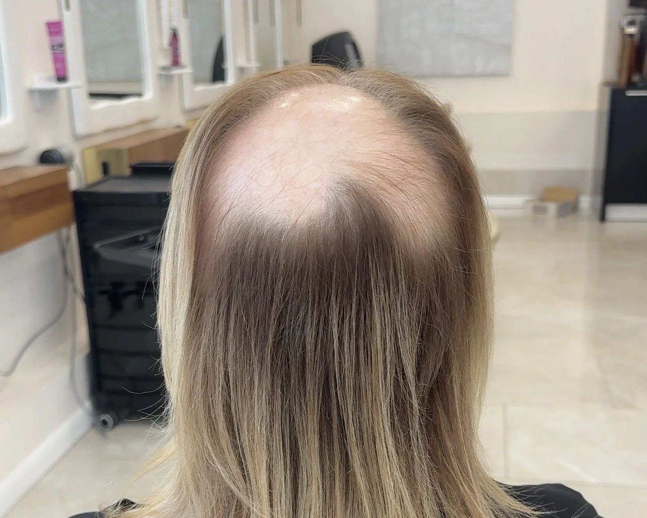 Crown thinning and reduced hair density in a female hair loss client before treatment.
