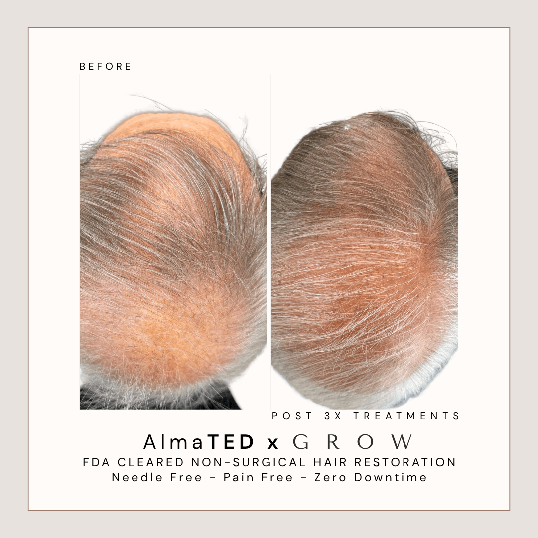 Before and after non-surgical hair restoration treatment for male crown thinning in Atlanta.