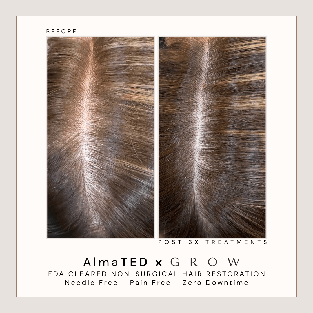 Top-down before and after results from non-surgical AlmaTED hair restoration treatment.