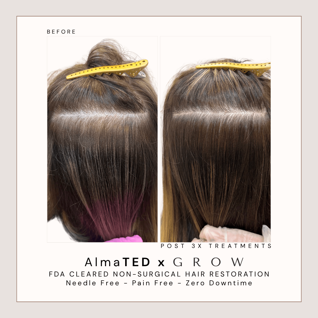 Before and after AlmaTED treatment for traction alopecia and crown hair loss at GROW Hair Lounge.