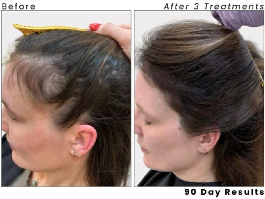 AlmaTED® needle-free hair restoration technology for thinning hair and scalp health.