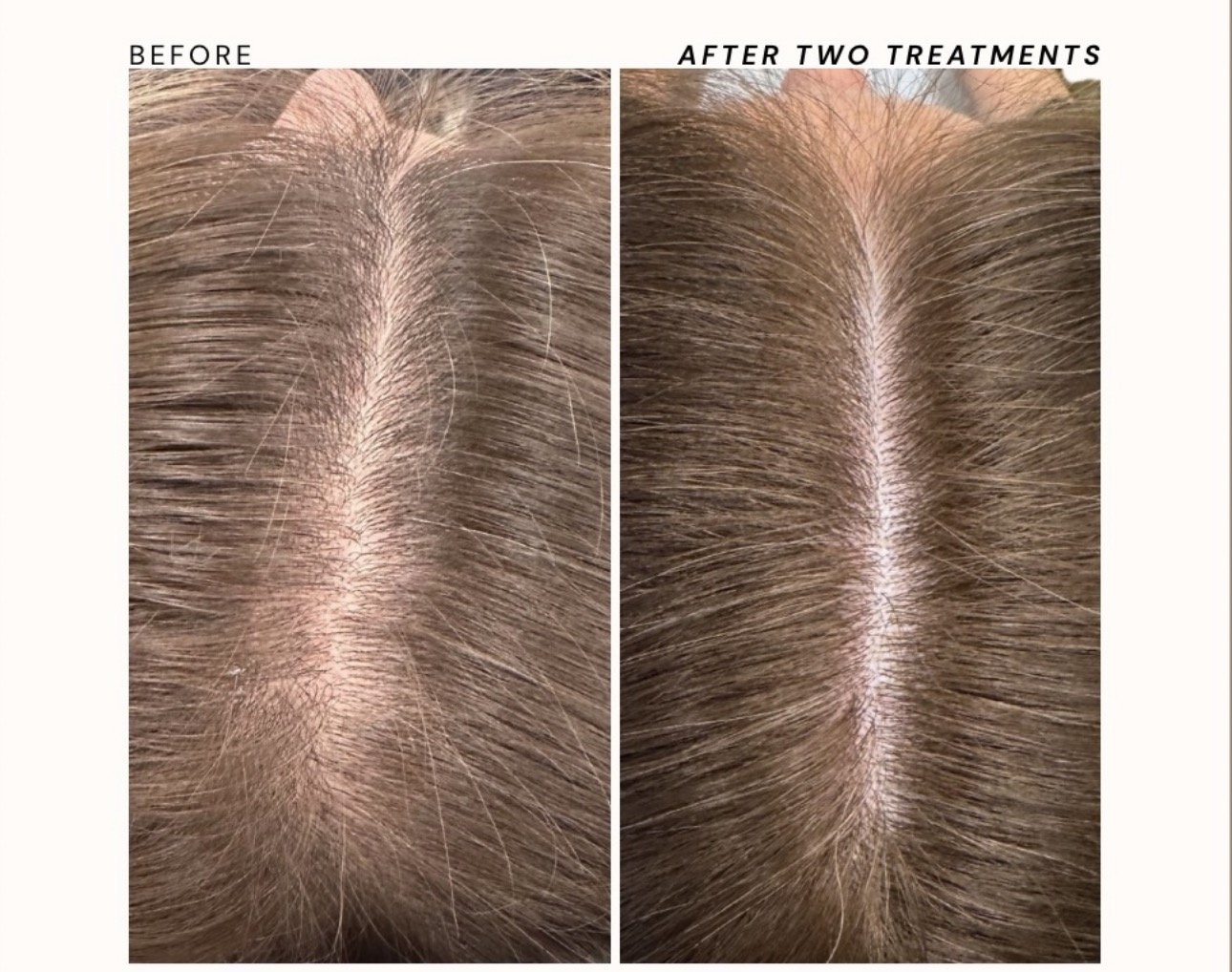 Before and after AlmaTED® hair restoration treatment showing improved hair density and reduced scalp visibility.