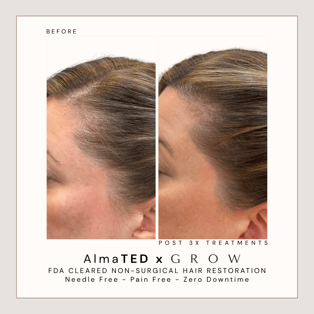 Before and after female frontal hairline restoration treatment using AlmaTED hair restoration.
