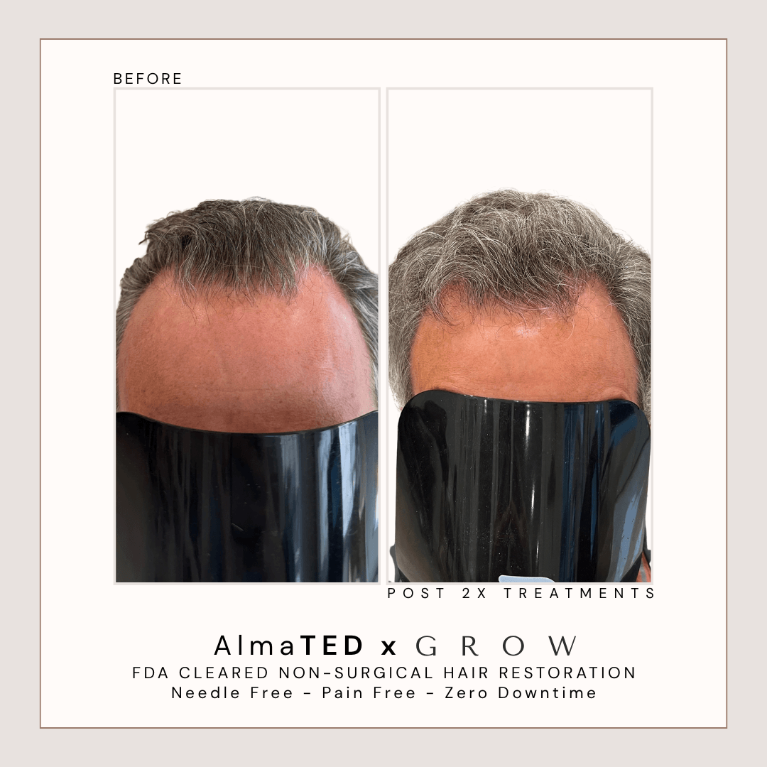 Before and after male hairline restoration using non-surgical hair restoration treatment.