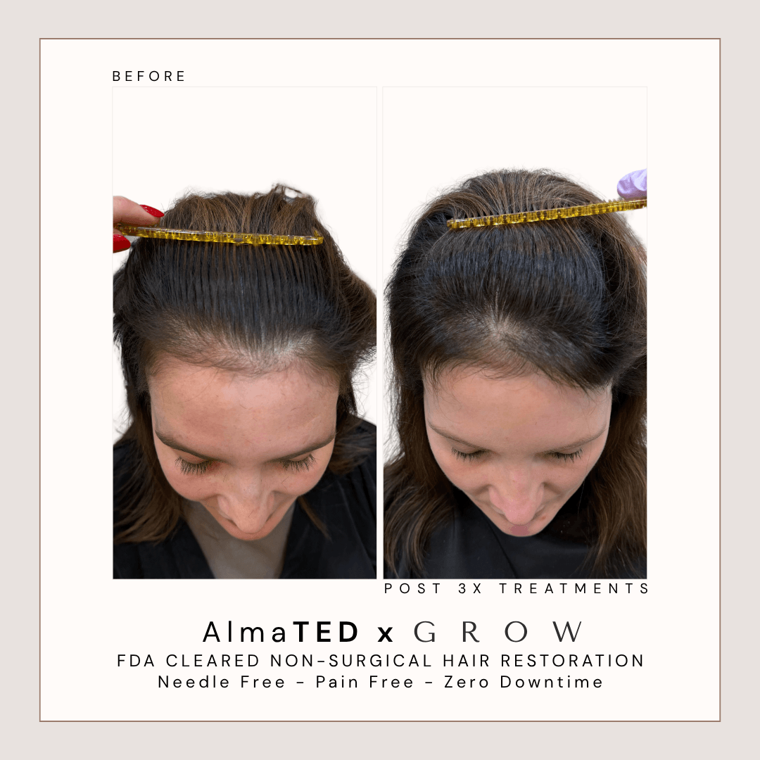 Before and after treatment for female hairline thinning and scalp visibility using AlmaTED.