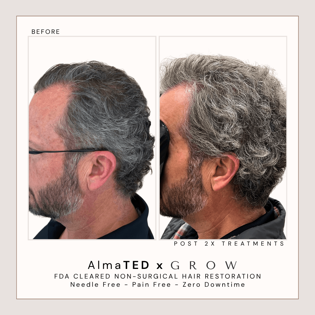 Before and after AlmaTED treatment for thinning hair on the top of the head in male client.