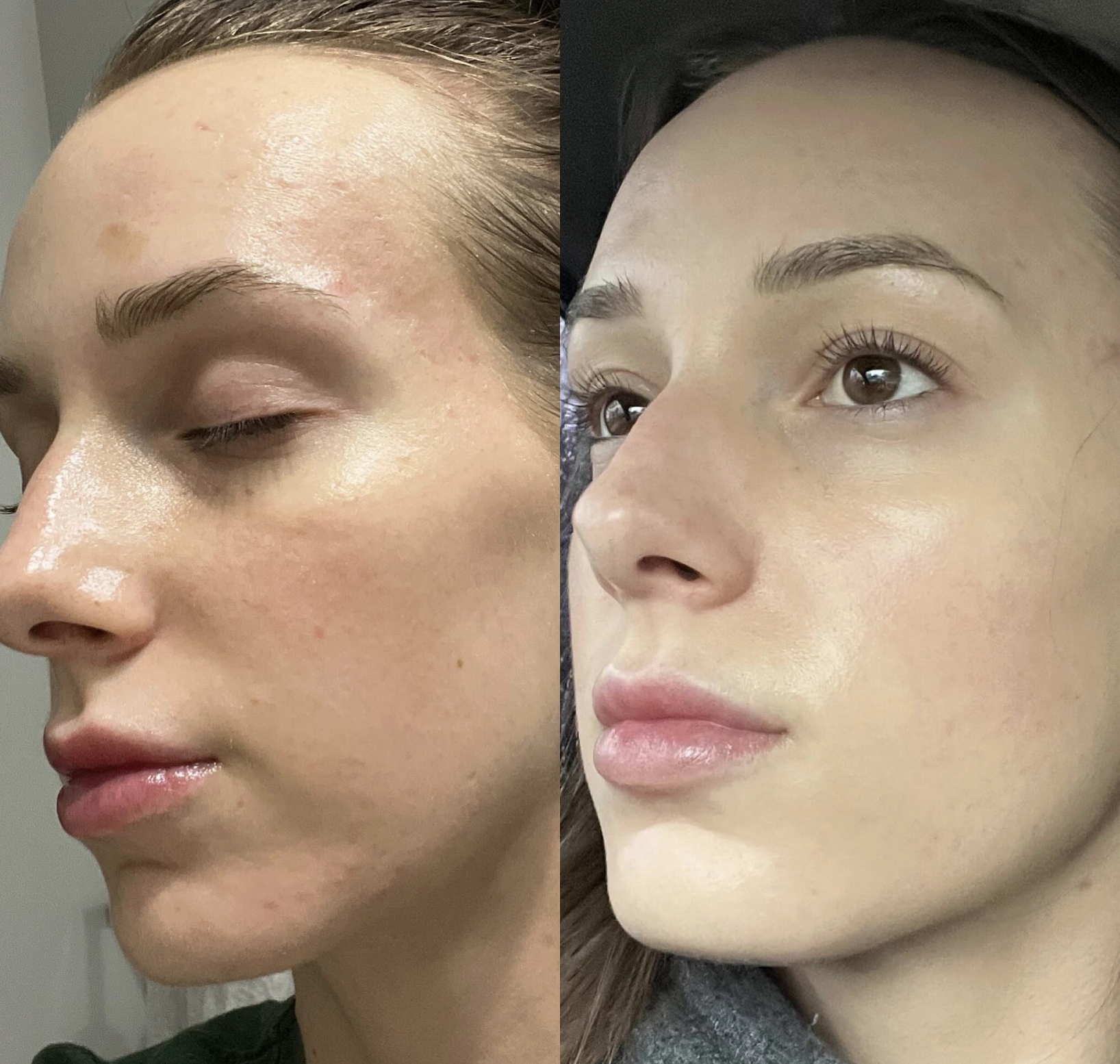 A side-by-side comparison of a woman's face, showing skin before and after long-term skincare treatment. The left image has visible skin imperfections and uneven tone, while the right image has clear, smooth skin with a natural glow.