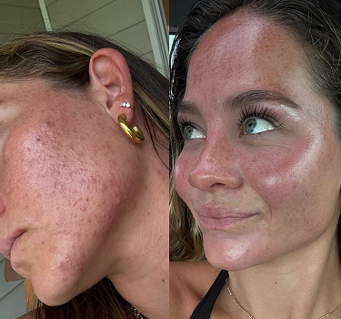 A side-by-side comparison of a woman's face, showing skin before and after long-term skincare treatment. The left image has visible skin imperfections and uneven tone with visible acne, the right image is more clear and glowy.