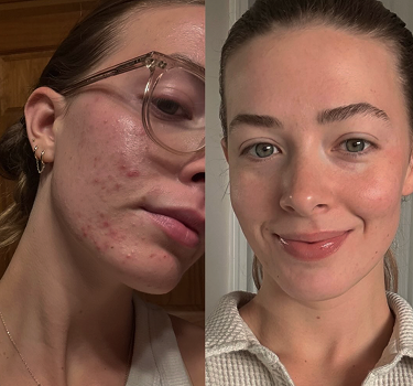 Side-by-side photo showing a woman with facial acne before and after treatment, with clear skin in the after picture.