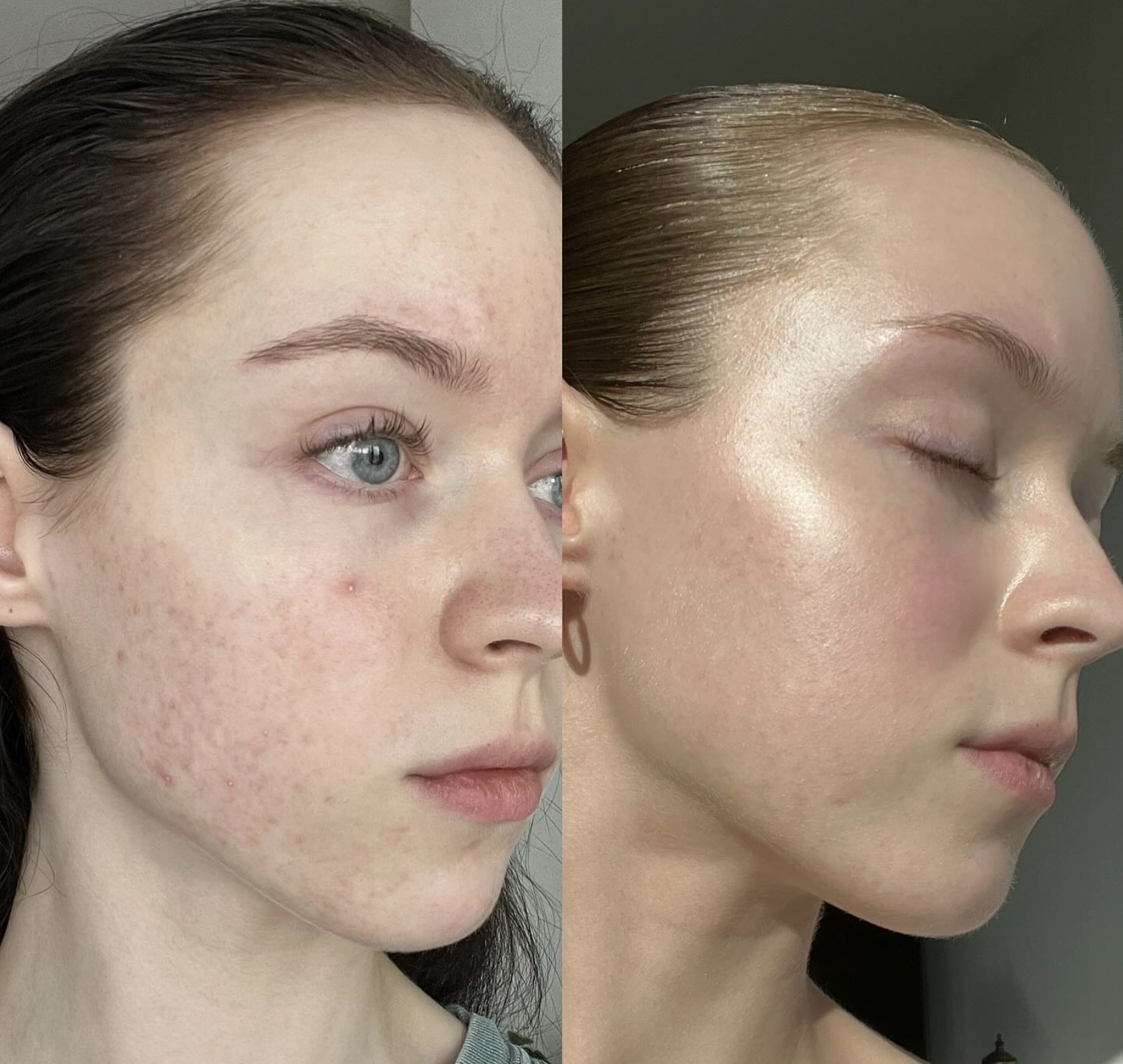 Side-by-side comparison of a woman before and after skincare treatment, showing clear improvement in skin texture and smoothness.