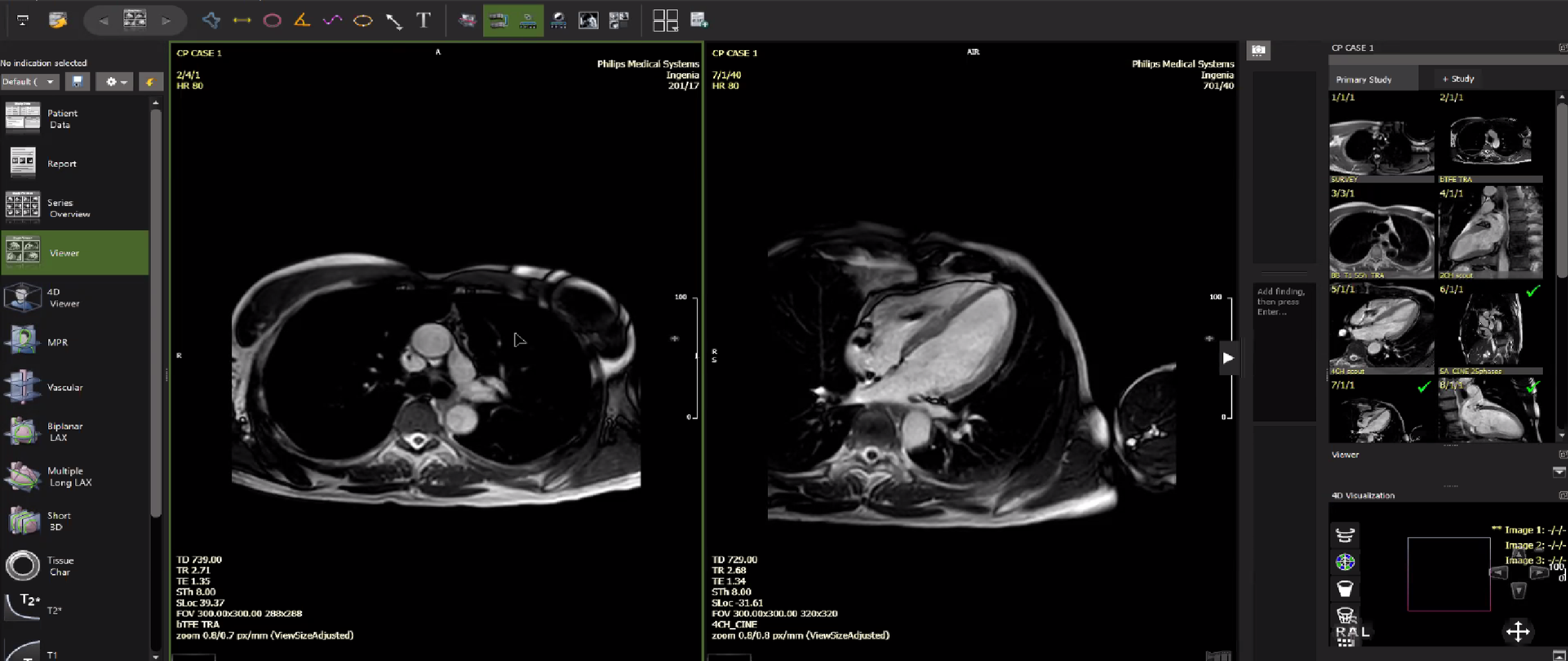 Cardiac+mri+pacemaker+on+left.png