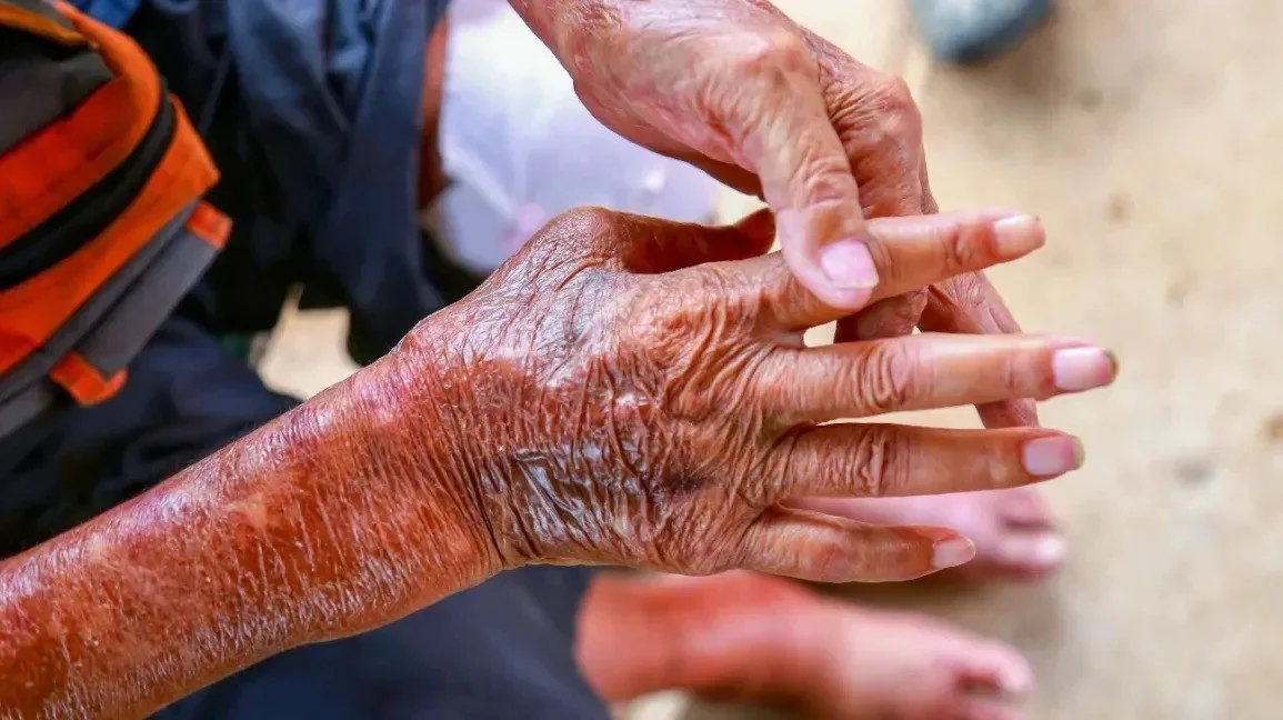 A close-up image of a woman's hands who has the medical condition scleroderma