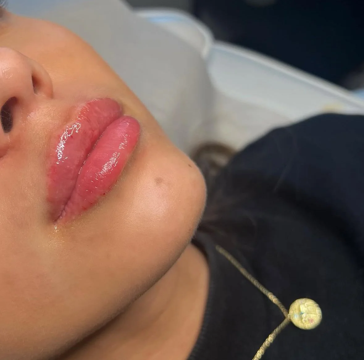 Fillers