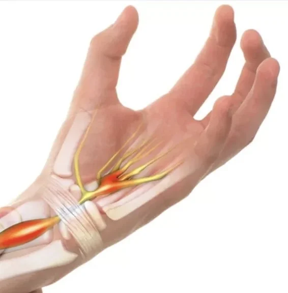 An anatomical illustration of the nerves, muscles, and tendons in a human hand, highlighting nerve pathways and muscle structure.