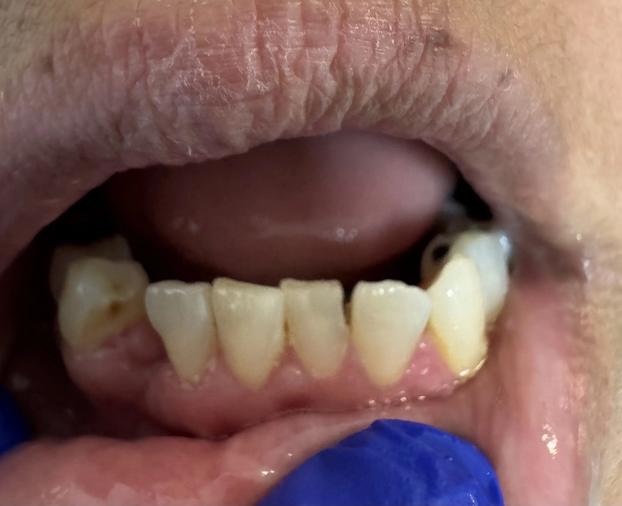 Close-up of a person's open mouth showing severely decayed and discolored teeth, with visible cavities and plaque.
