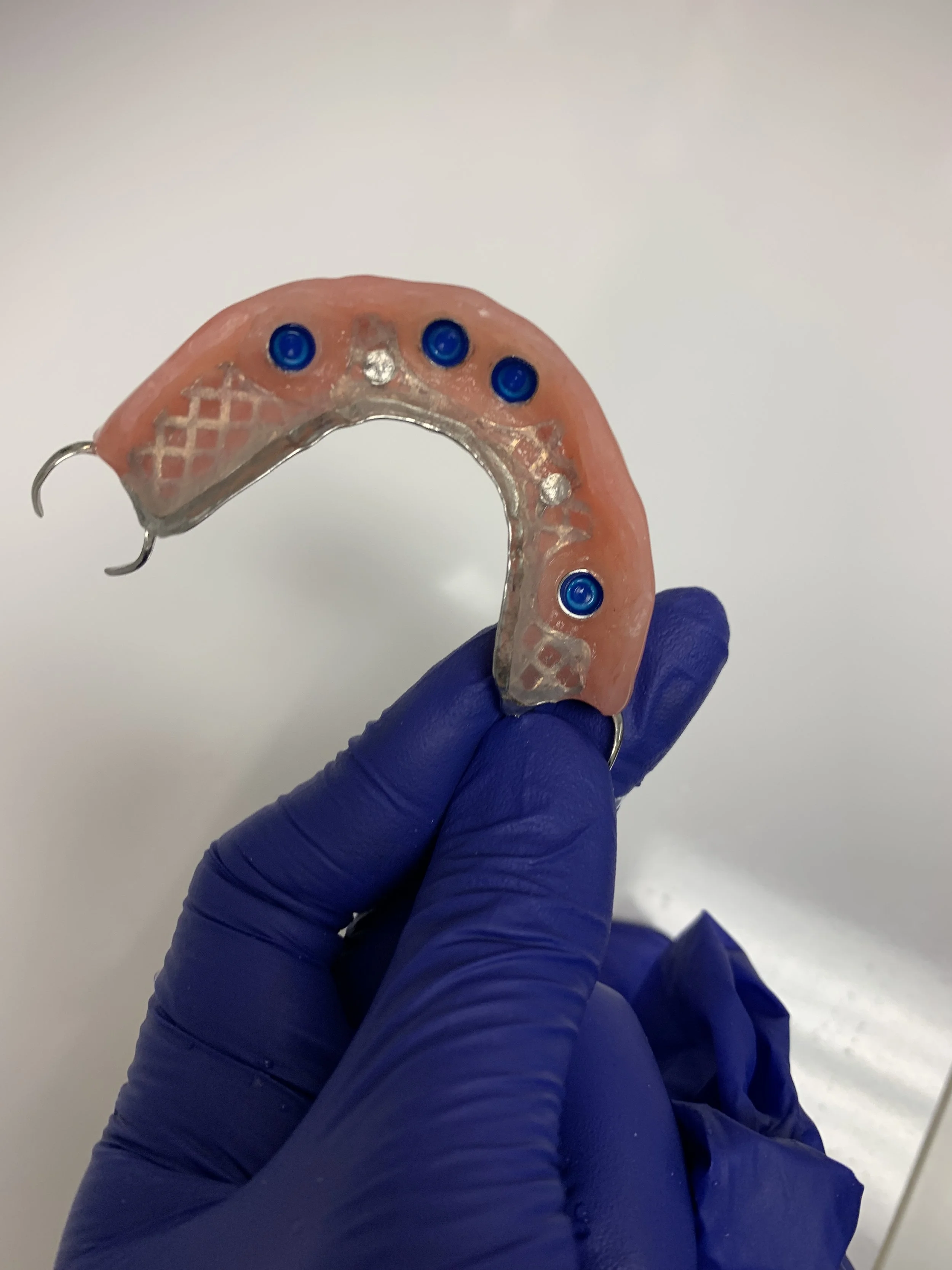 A person wearing a blue glove holding a dental prosthetic device with metal framework and pink acrylic base, containing several blue and metal retention components.