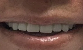 Close-up of a person's mouth with visible teeth and lips.