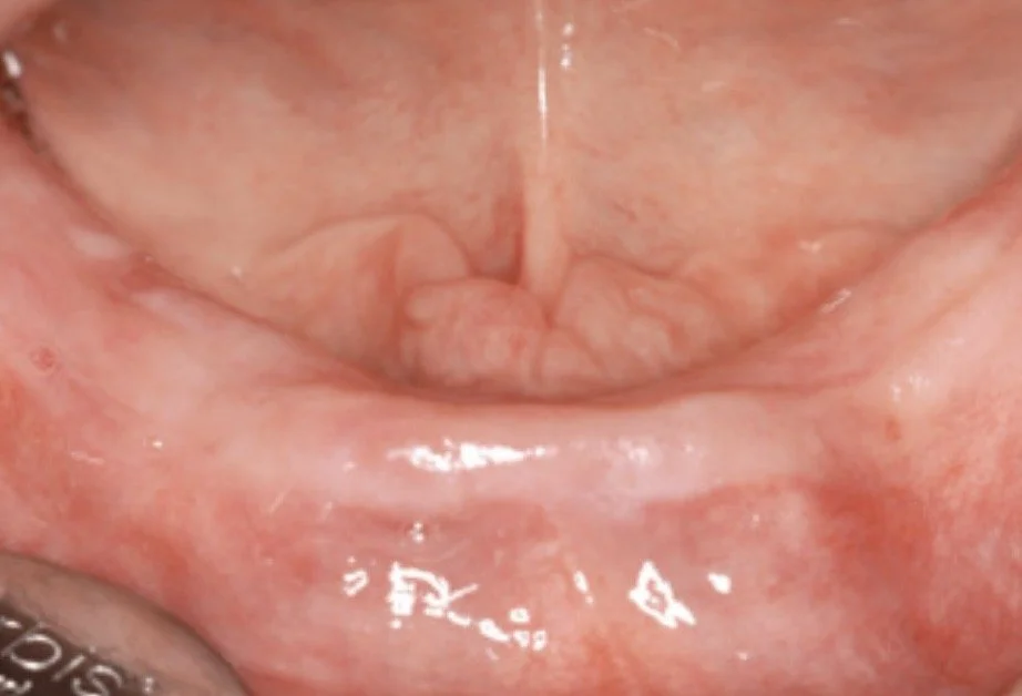 Close-up of the inside of a person's mouth showing the tongue and lower gums.