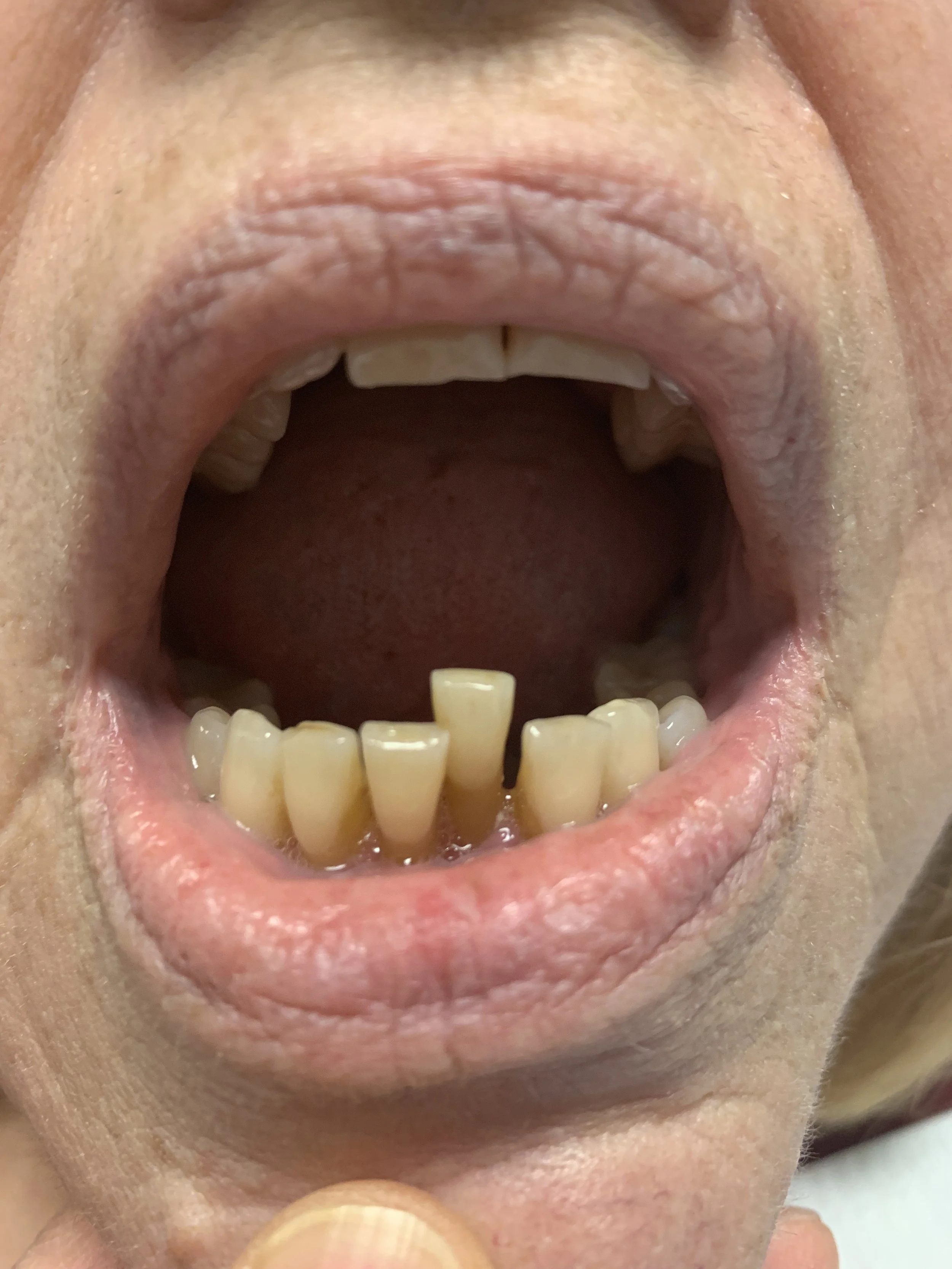 Close-up of an open mouth showing yellowed and missing teeth.