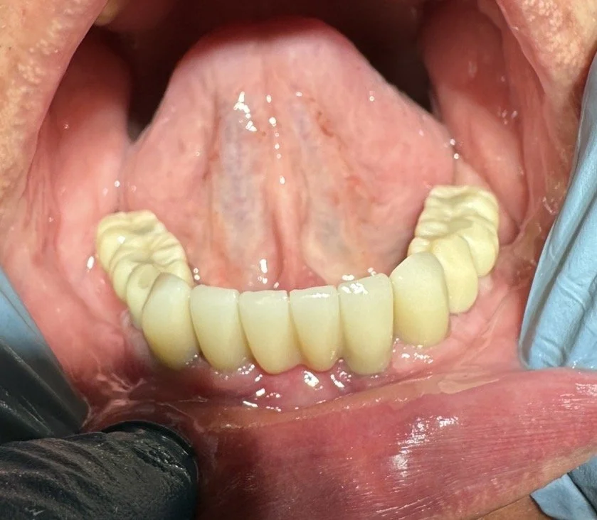 Lower teeth with dental prosthetics or crowns, visible tongue and inner mouth
