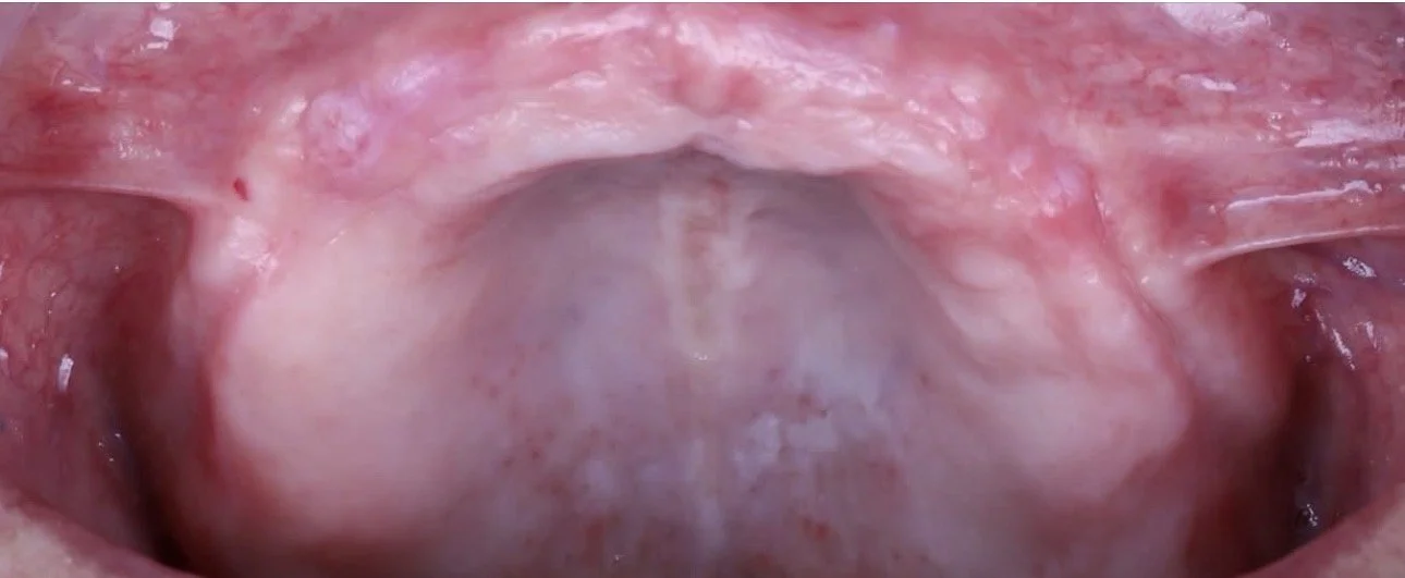 Close-up view of the inside of a human mouth, showing the throat and uvula.