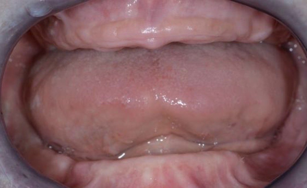 Close-up of the inside of a human mouth showing the tongue, teeth, gums, and the roof of the mouth.
