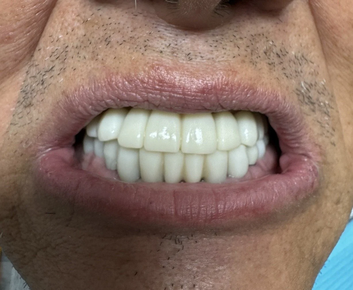 Close-up of a person's mouth showing white teeth and lips, with some facial hair and skin texture visible.