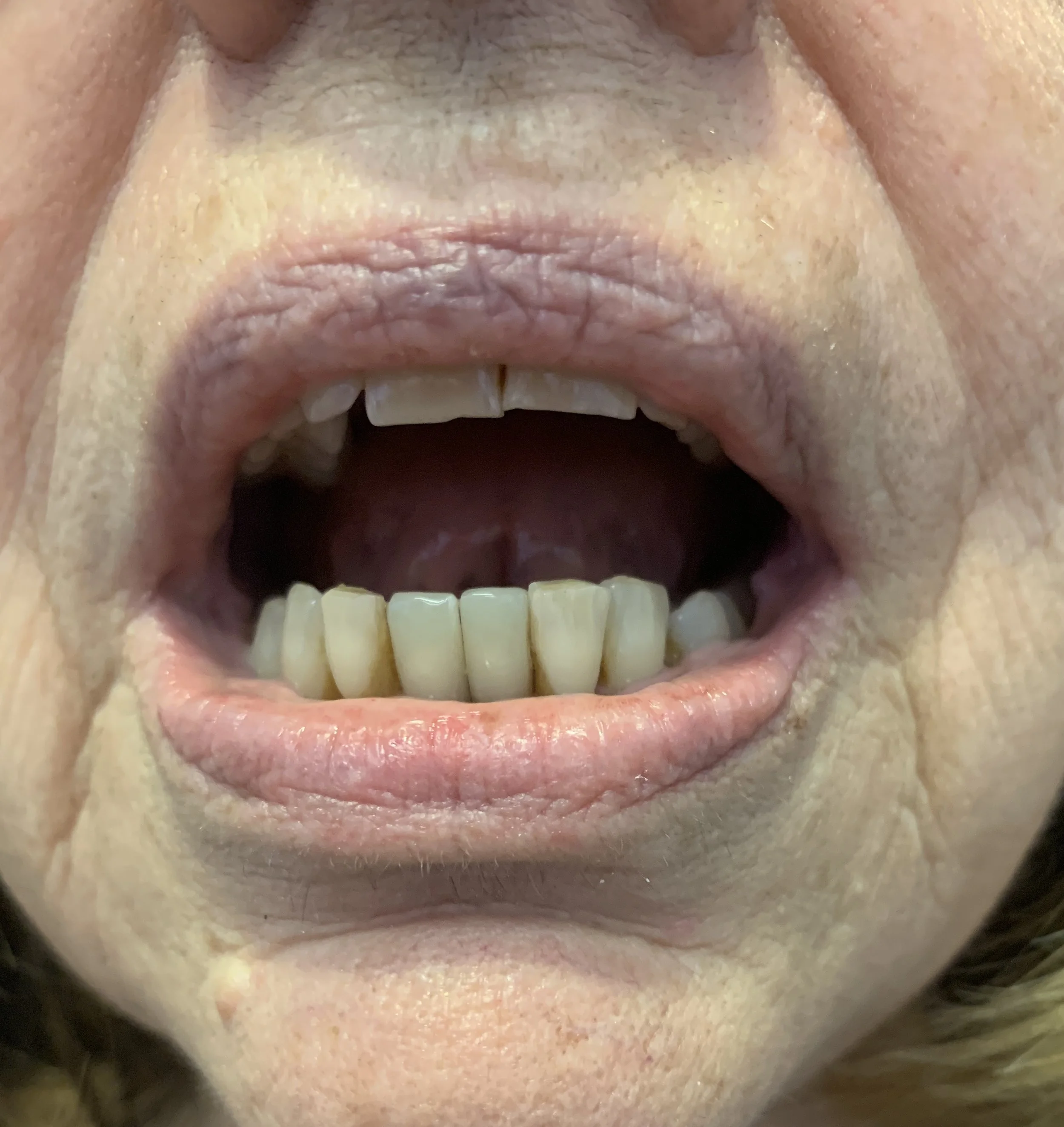 Close-up of an open mouth with missing and discolored teeth.
