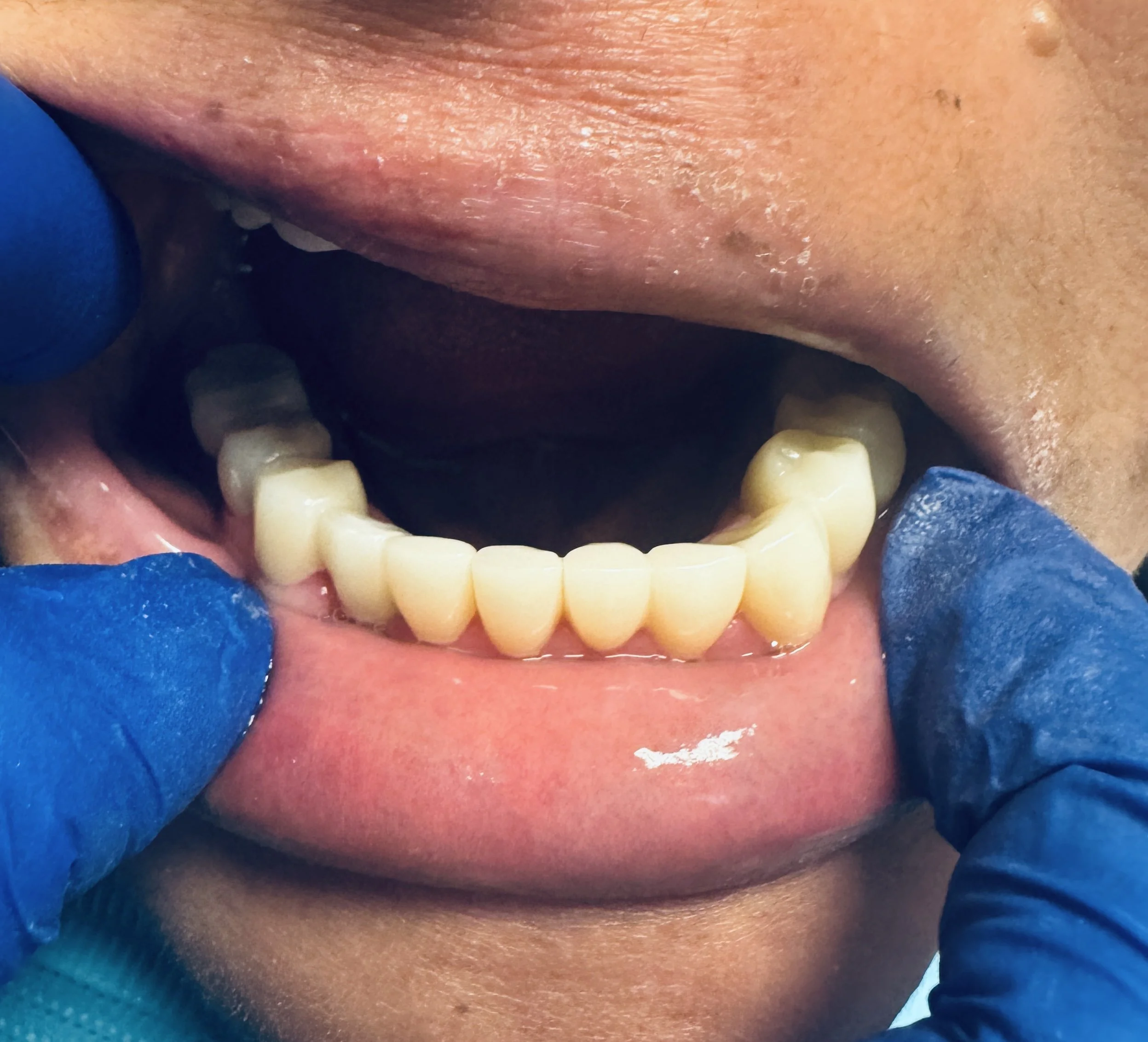 Close-up of a person with dental gloves showing their lower teeth, some of which are covered with dental crowns or caps.