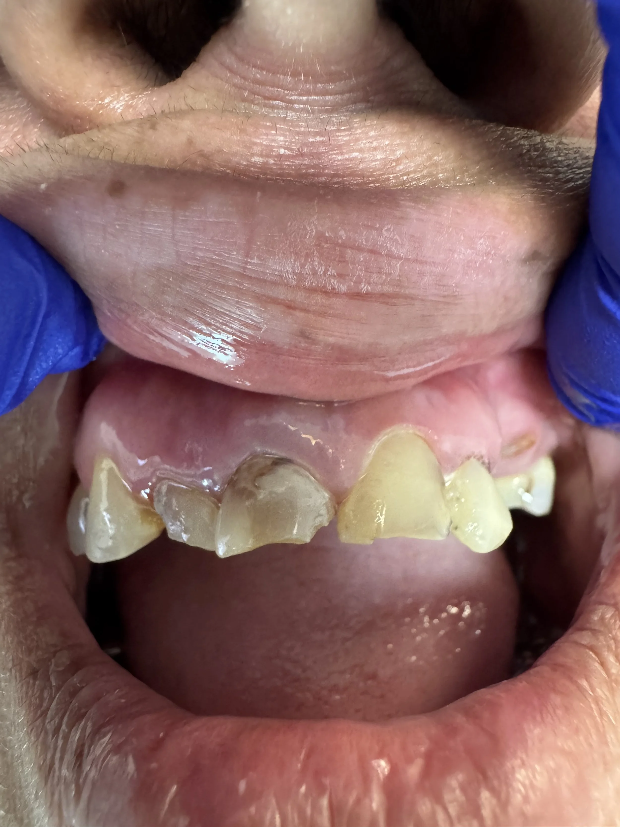 Close-up of a person's mouth with severely damaged, discolored, and broken front teeth, held open with gloved fingers.