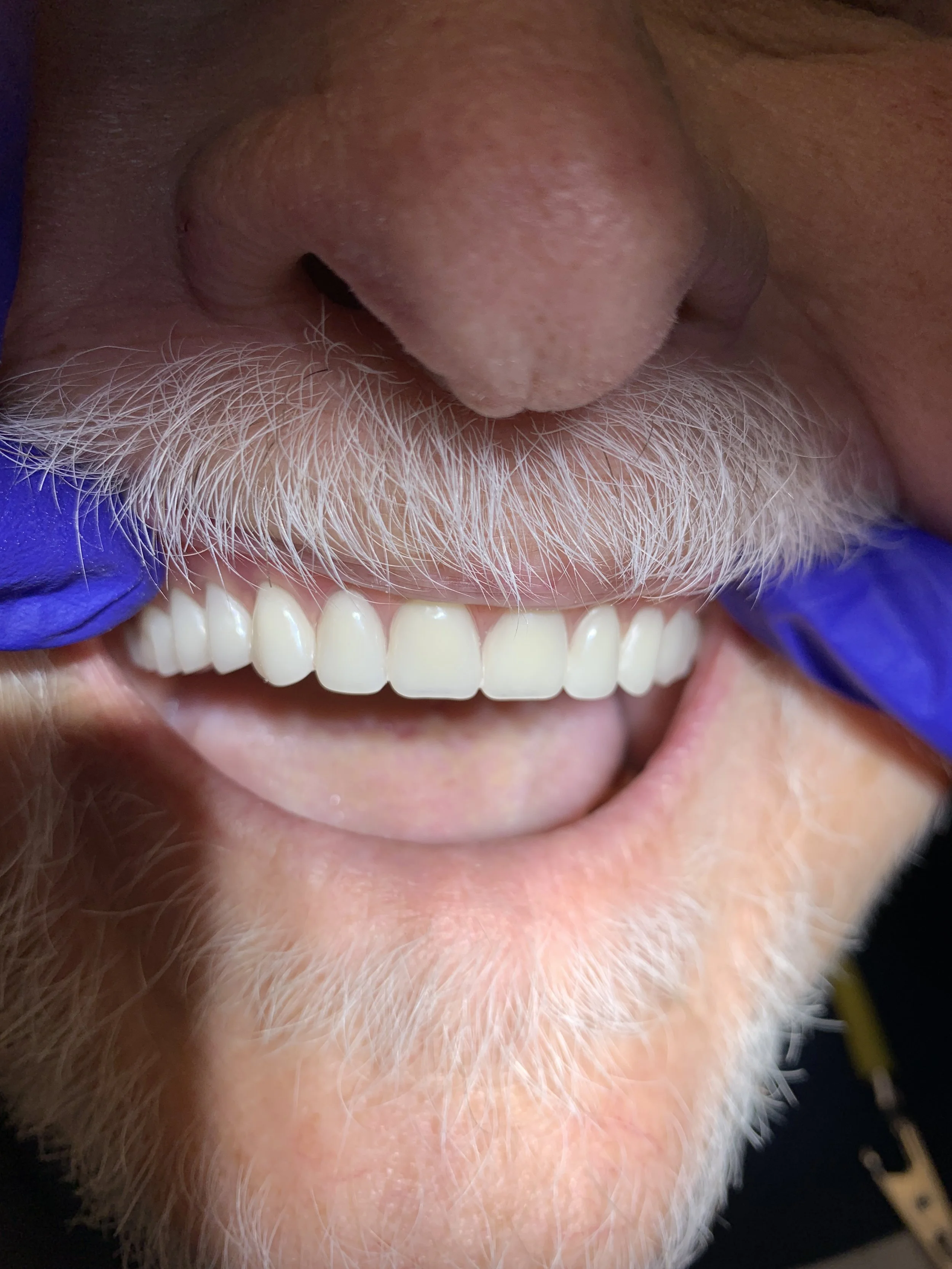 Close-up of an elderly man's smiling mouth showing his teeth, with a mustache and beard visible, and a gloved hand pulling up the lip to reveal the teeth.