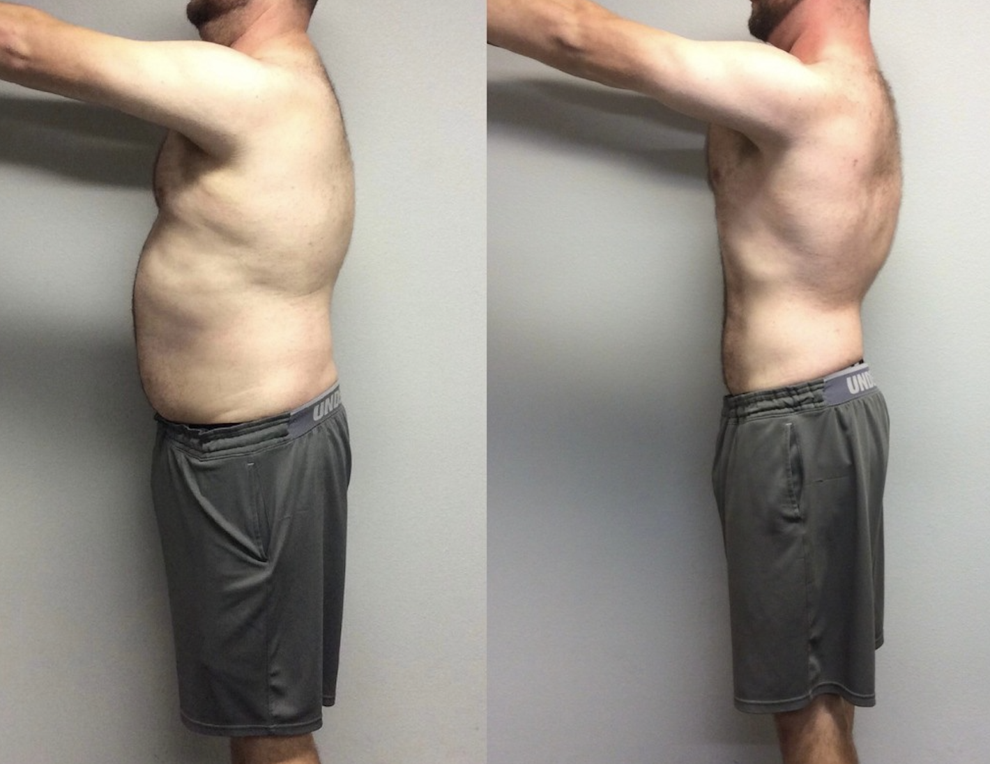 Side-by-side comparison of a man's torso before and after weight loss, showing reduced abdominal fat and a slimmer profile.