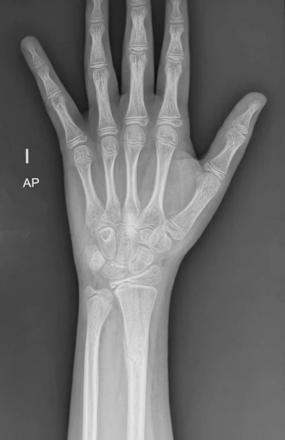 Radiografía de mano y muñeca revisada durante la valoración