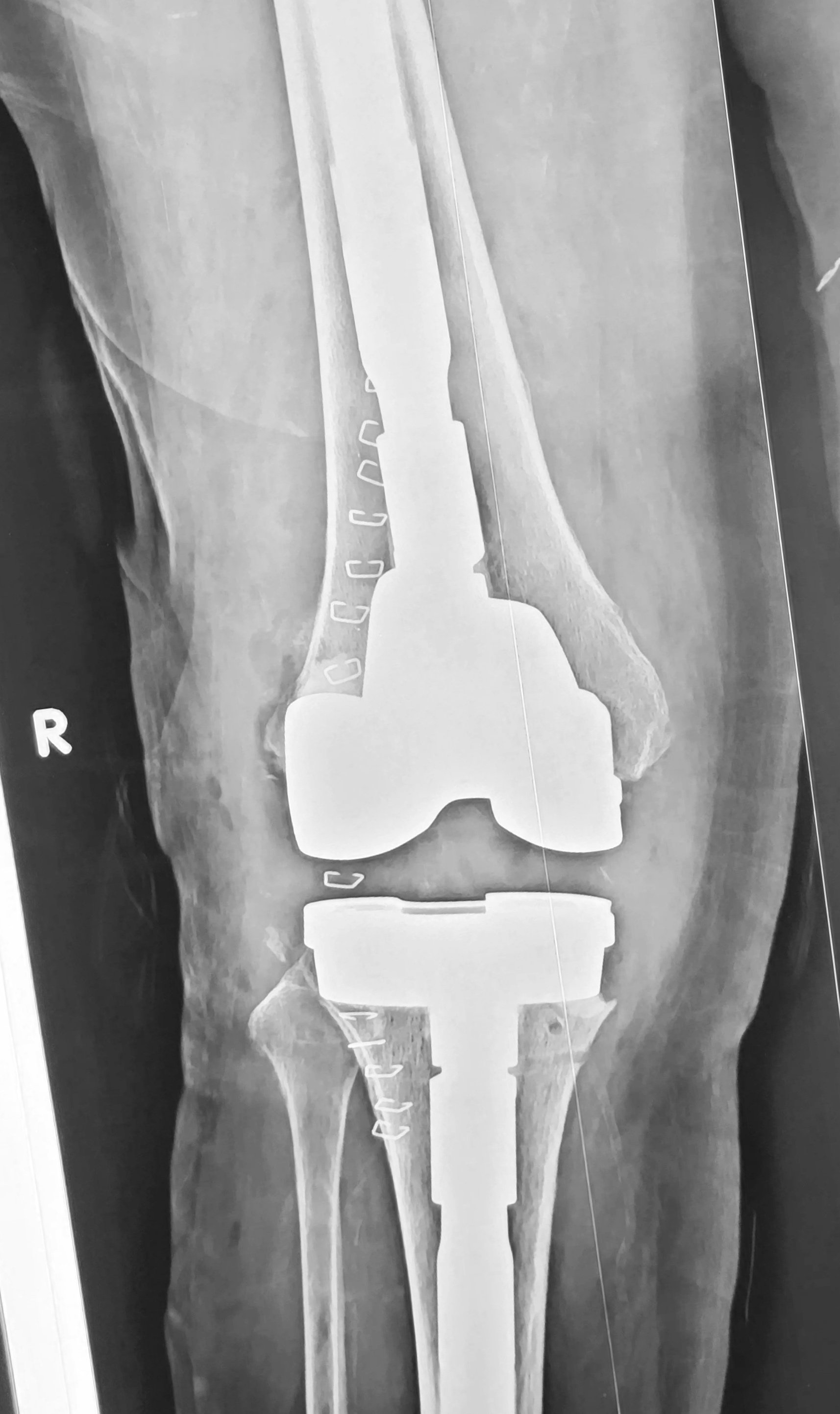 Imagen de una radiografía de la pelvis y las piernas, mostrando un reemplazo de cadera con implantes y tornillos.