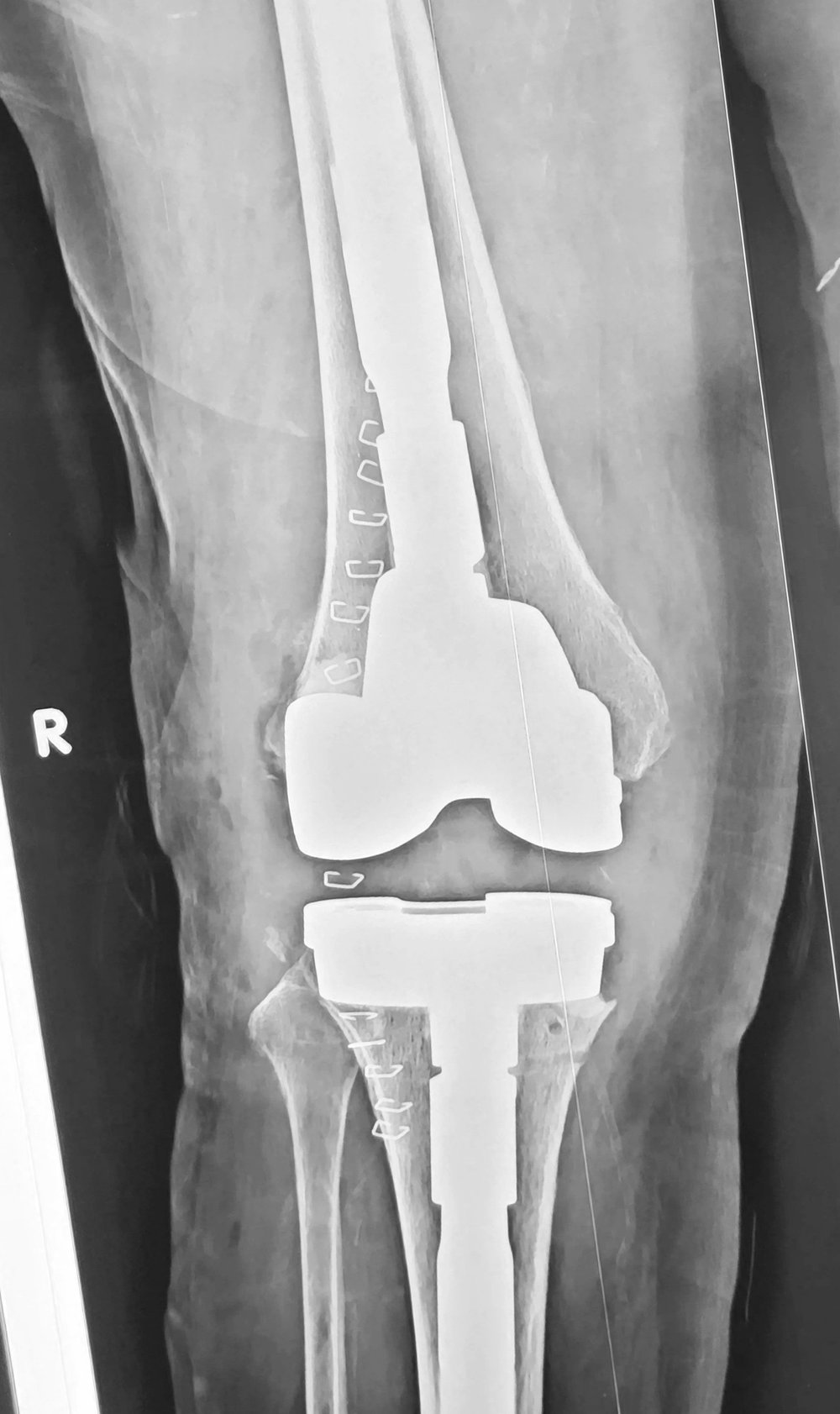 Radiografía de una prótesis de rodilla con vástagos largos