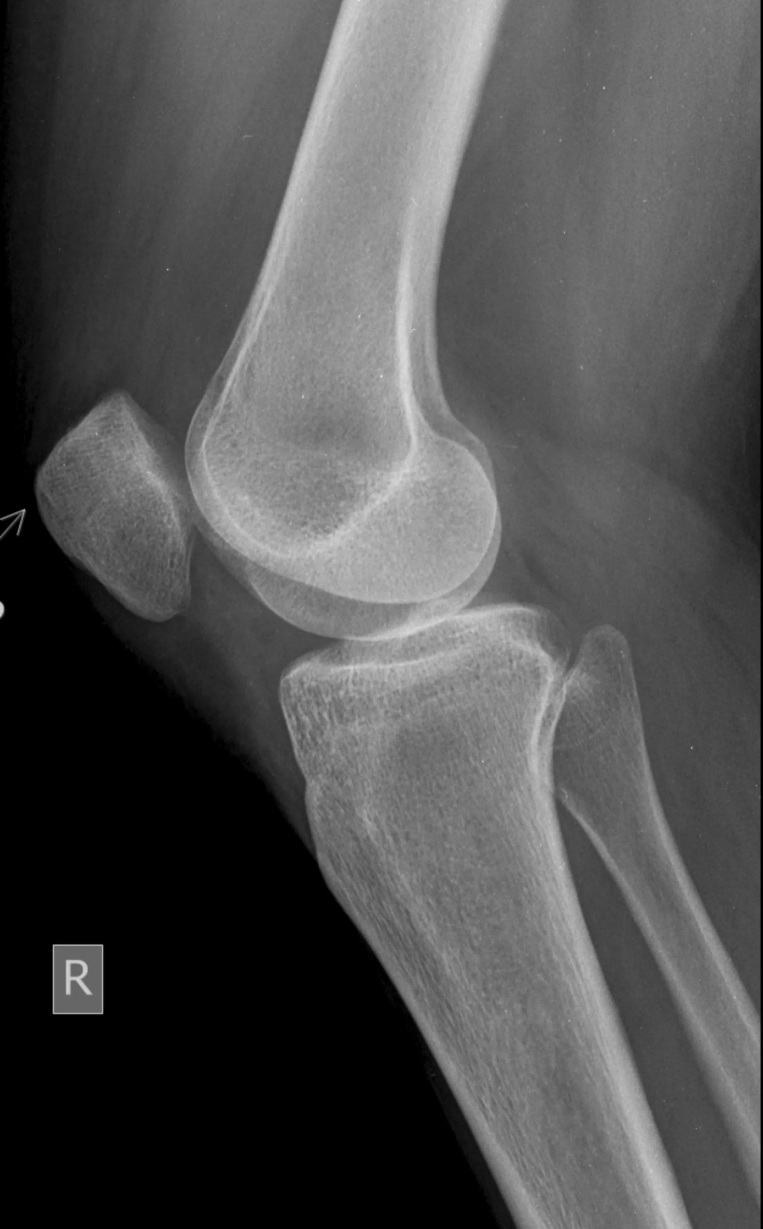 ¿Cuándo es necesaria una prótesis de rodilla?