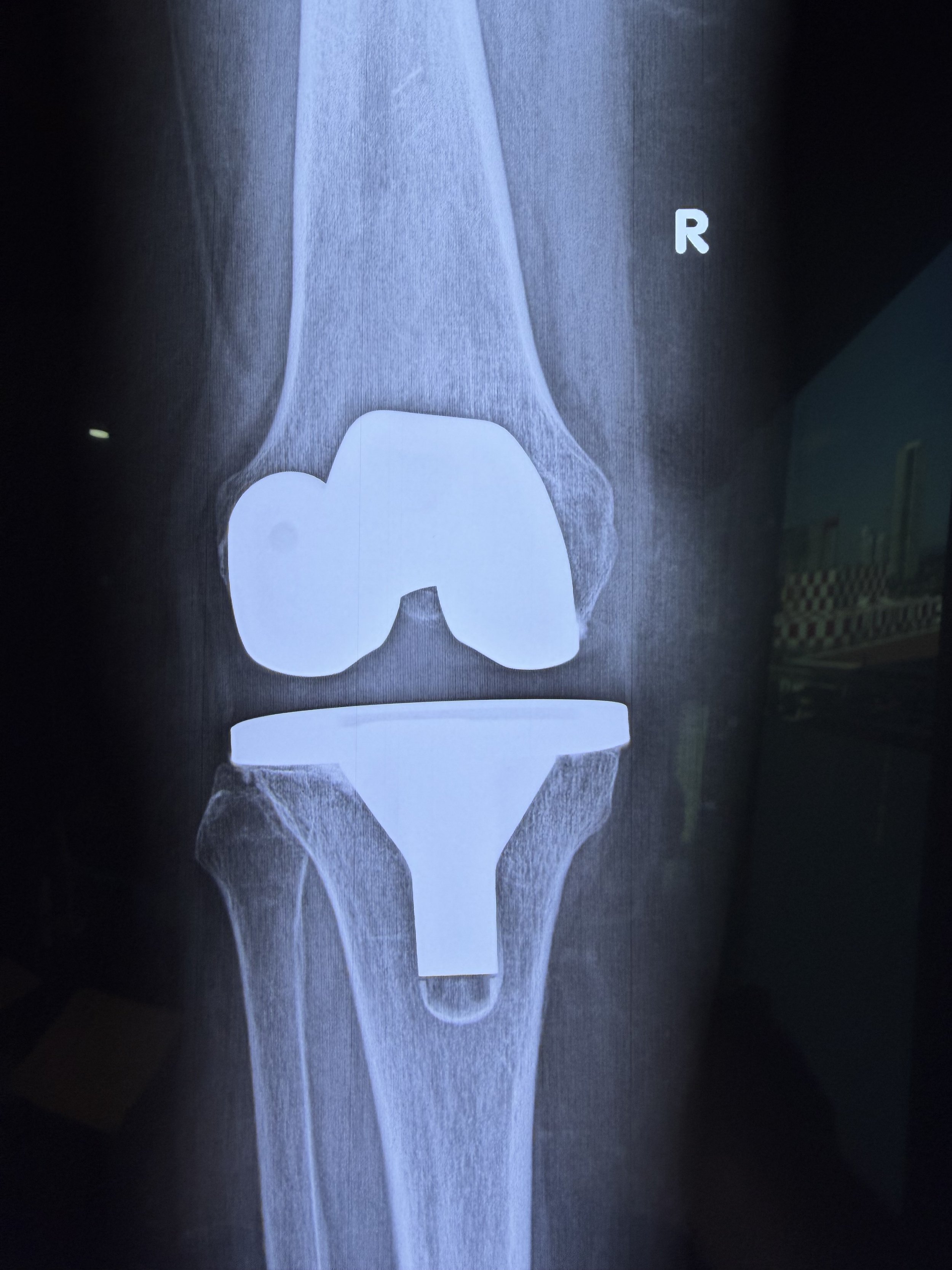 ¿Cuánto dura una prótesis de rodilla?