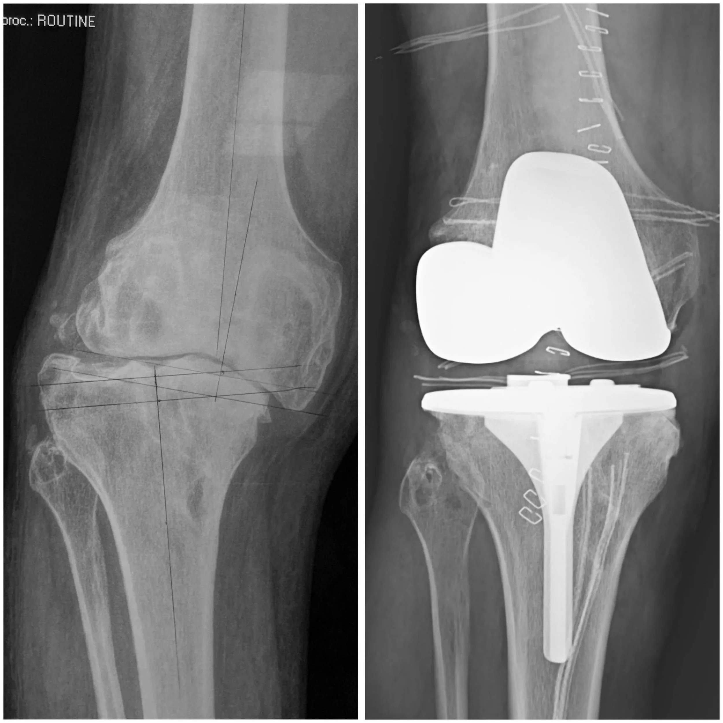 Paciente de 34 años co prótesis de rodilla.