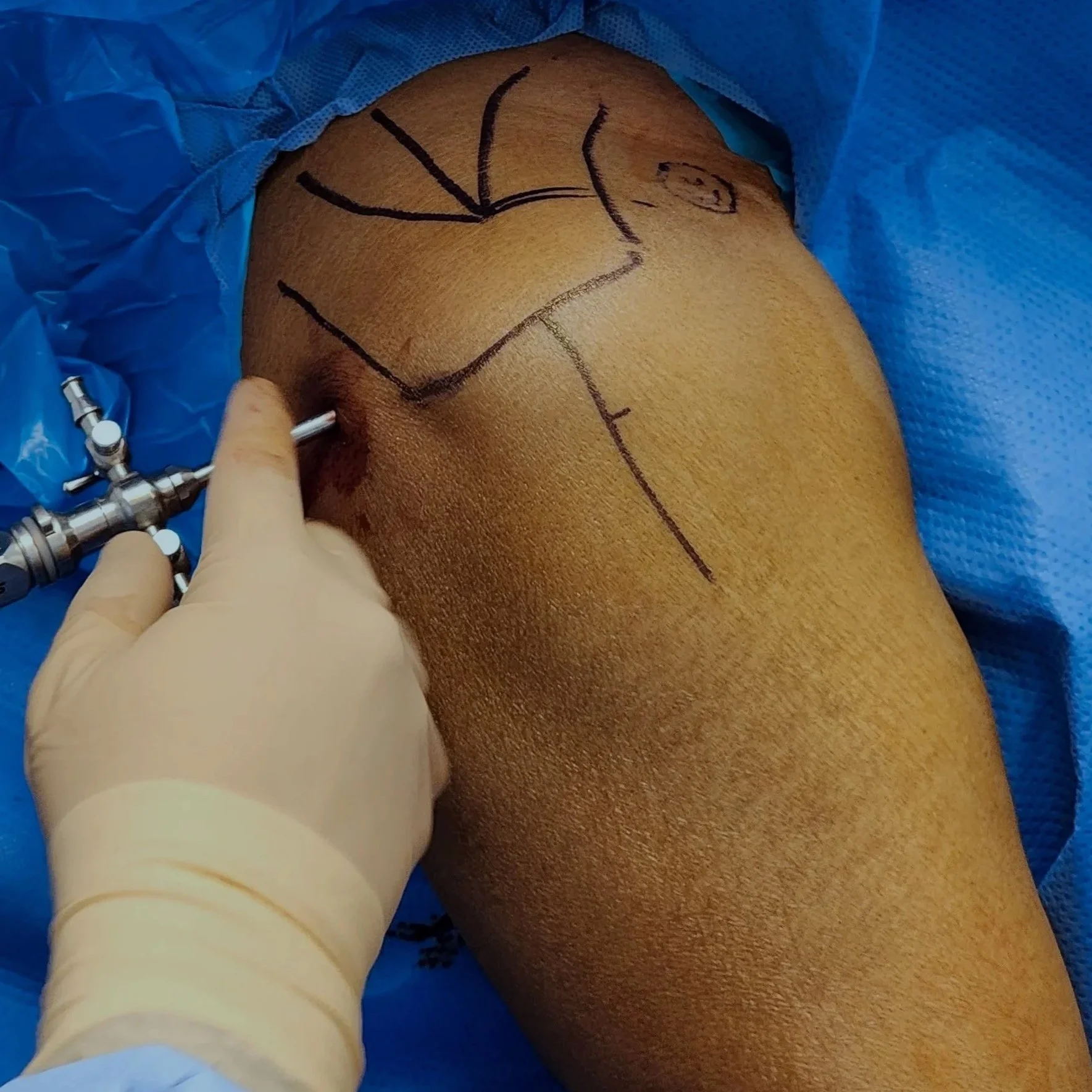 Procedimiento quirúrgico en muslo umano, con líneas trazadas y equipo médico, incluyendo un tubo y monitores.